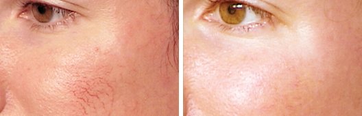 Leg Vein/Spider Vein &#038; Facial Vessel Treatments