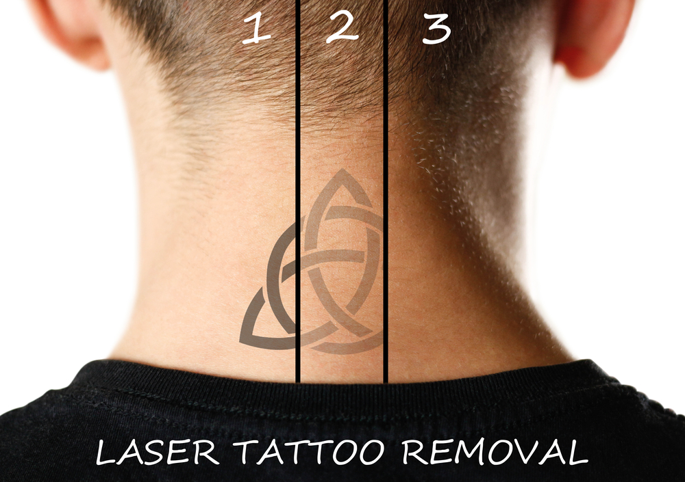 4 Factors That Contribute to the Cost of Laser Tattoo Removal