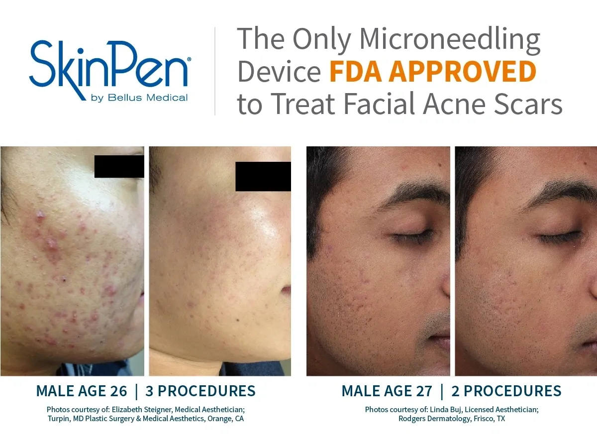 A picture of the side effects of microneedling.