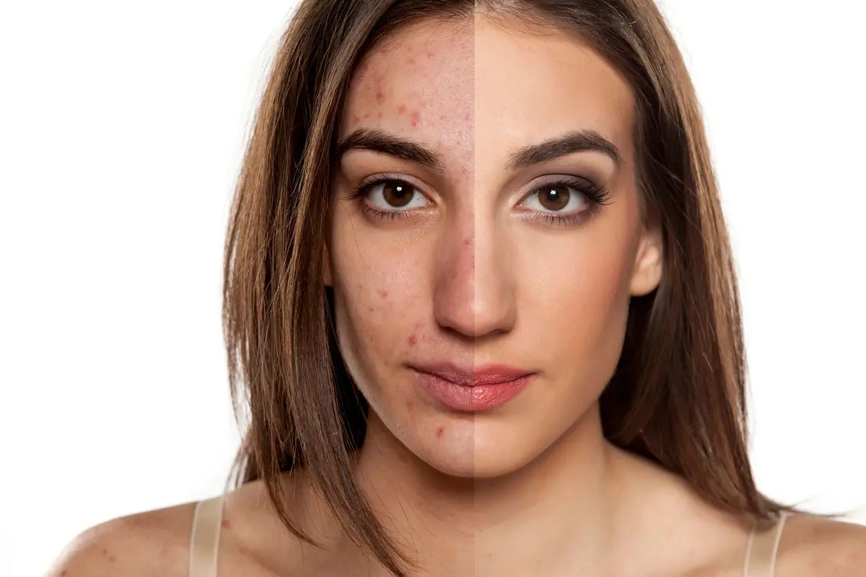 A woman with acne and dark spots on her face.
