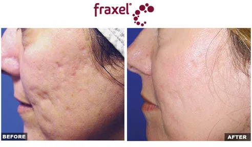 A woman with acne and before and after