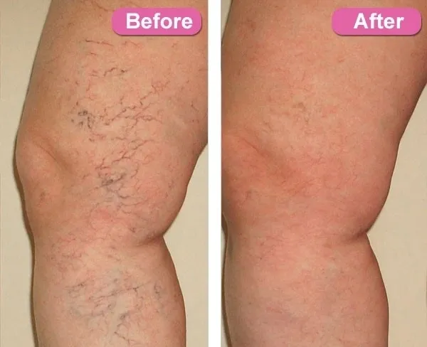 A before and after picture of the legs of someone with spider veins.