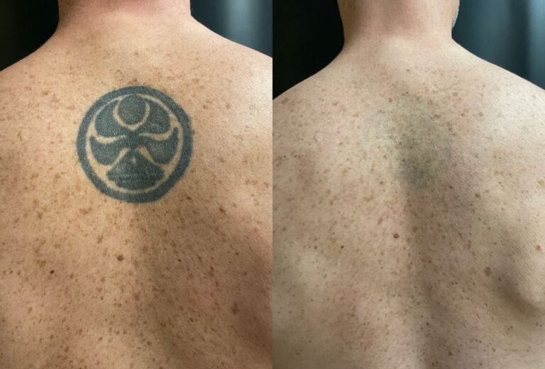 Before & After Tattoo Removal