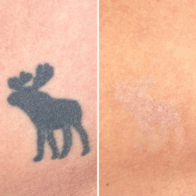 Before & After Tattoo Removal