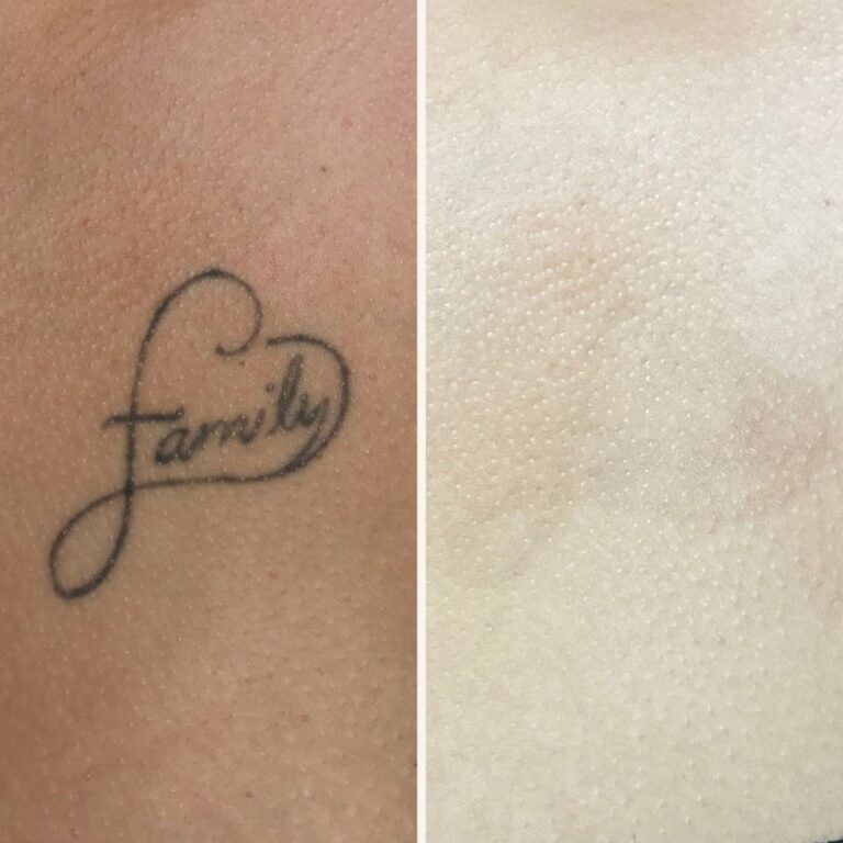 Before & After Tattoo Removal