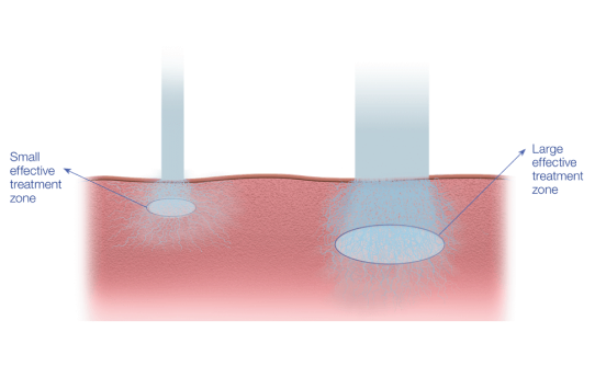 Laser Tattoo Removal