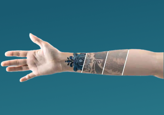 Laser Tattoo Removal