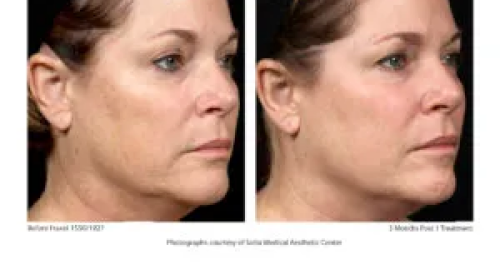 Before & After Juvenation