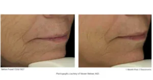 Before & After Juvenation