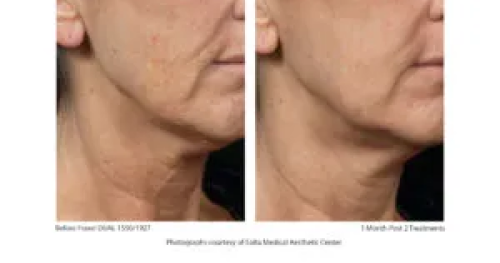 Before & After Juvenation