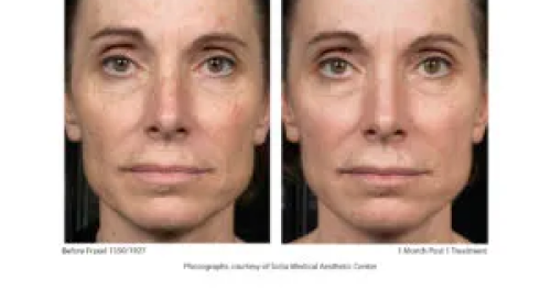 Before & After Juvenation