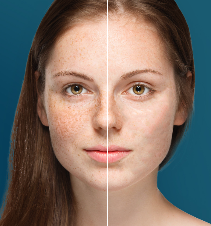 Photorejuvenation, Fraxel Dual, & Co2 Laser