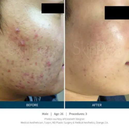 Before & After Microneedling