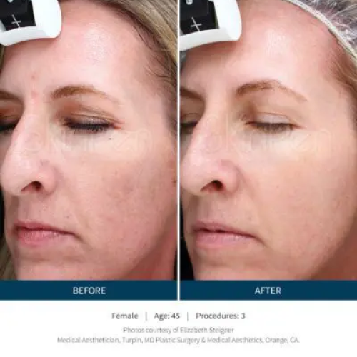 Before & After Microneedling
