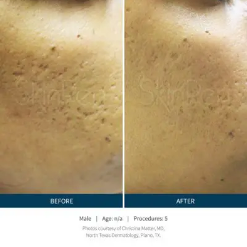 Before & After Microneedling