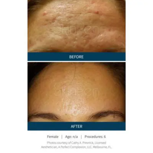 Before & After Microneedling