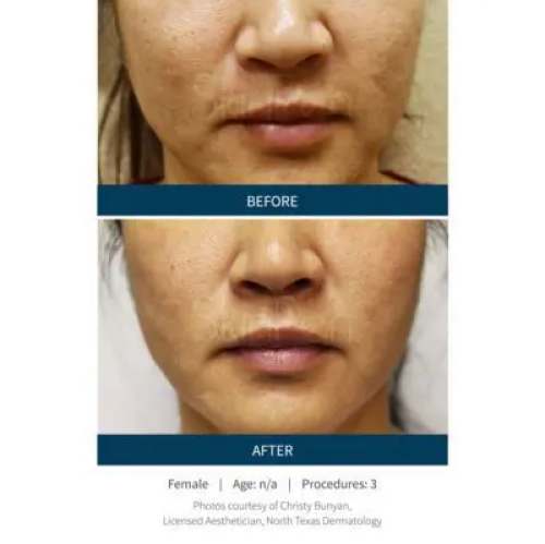 Before & After Microneedling